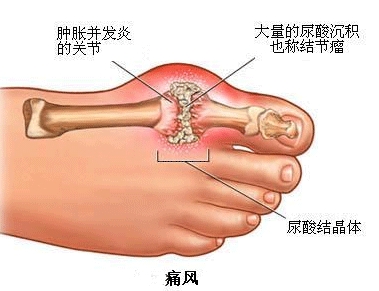 痛风是由嘌呤代谢紊乱造成的炎症反应,长期的尿酸盐结晶沉积于关节