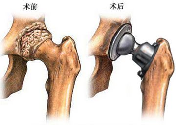 股骨头3.jpg