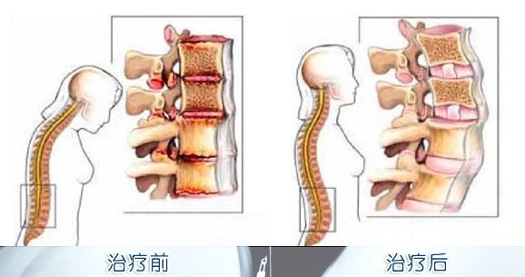 强直性脊柱炎1