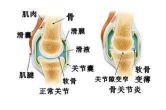 膝关节退行性改变.jpg