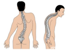 脊柱侧弯的发病原因.png